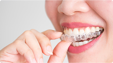 Invisalign®